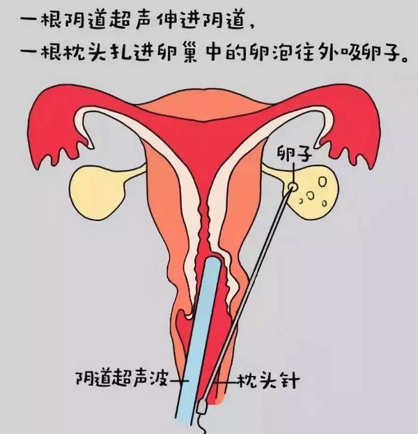 男人也能通过做供卵二代自怀试管生孩子吗？